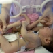 Роди се бебе с 8 крайника