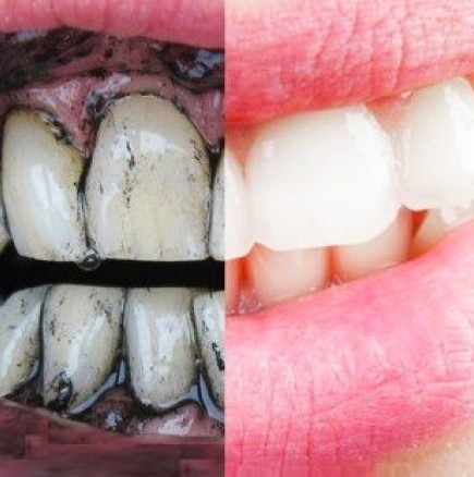 Избелете зъбите си с активен въглен