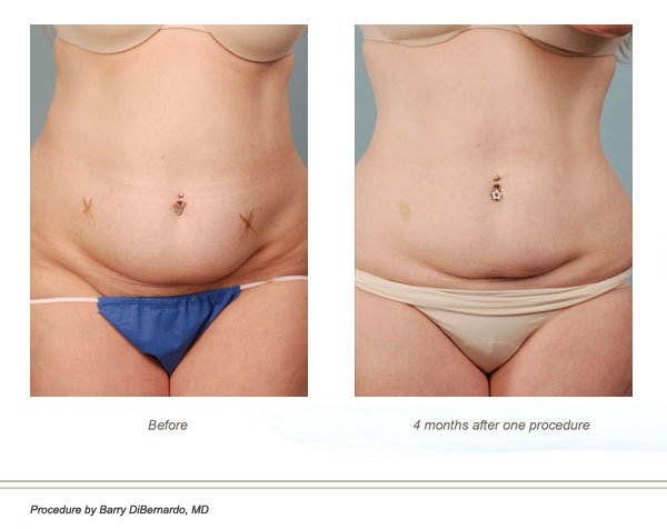 Cryolipolysis