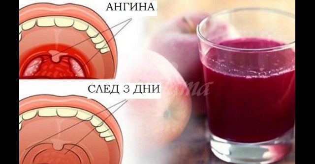 Лечение на ангина за 3 дни без антибиотици: След 4 часа симптомите ...