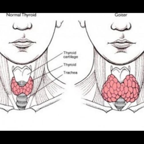 Нетоксический зоб щитовидной. Щитовидная железа рисунок. Узловой зоб щитовидной железы. Загрудинное расположение щитовидной железы.